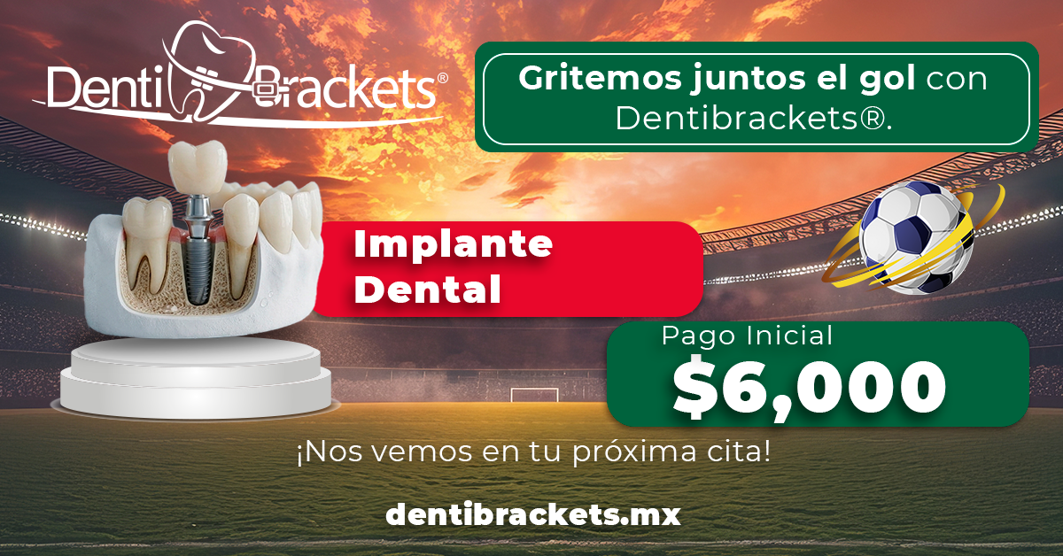dentibrackets®_implante dental_julio